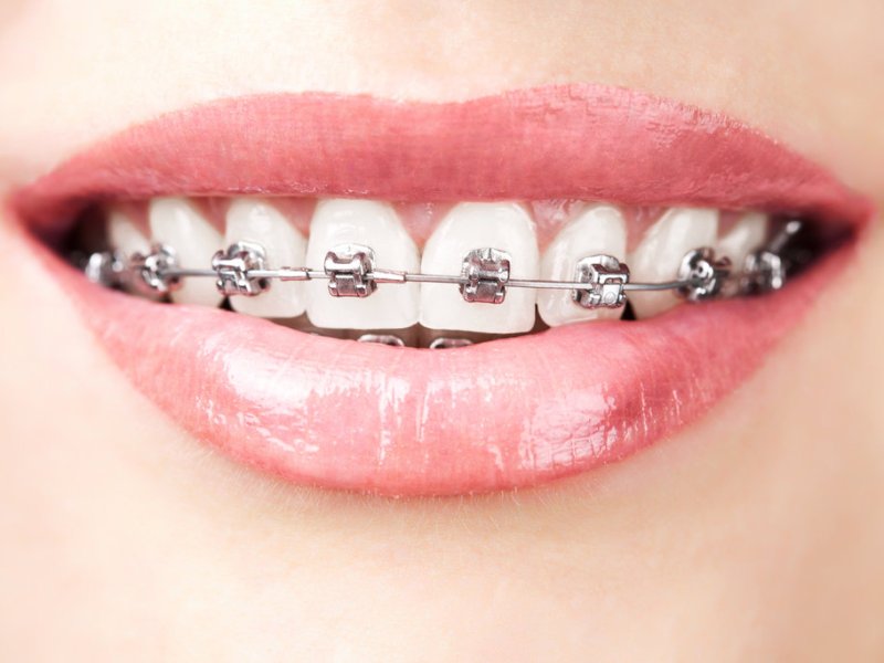Straightening Teeth With Modern Orthodontic&nbsp;Braces