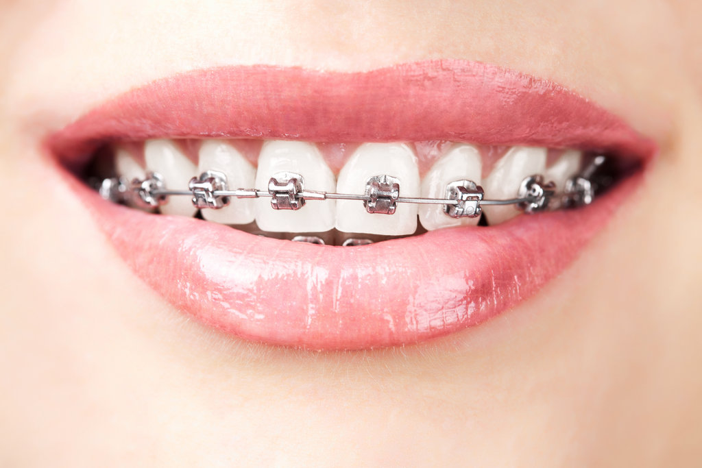 Straightening Teeth With Modern Orthodontic&nbsp;Braces